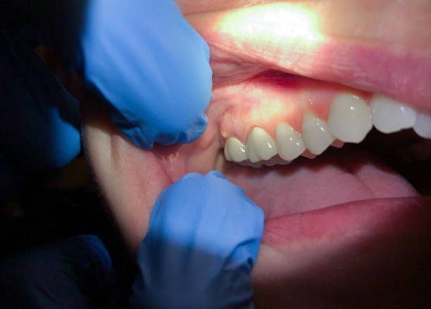 Best Emergency Tooth Extraction in La Riviera, CA